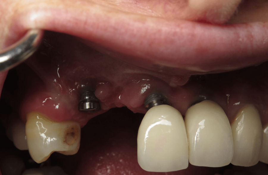 hueco entre implante y encía, implantes mal colocados