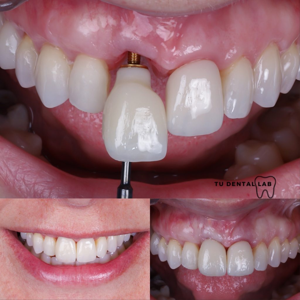 mejores marcas de implantes dentales