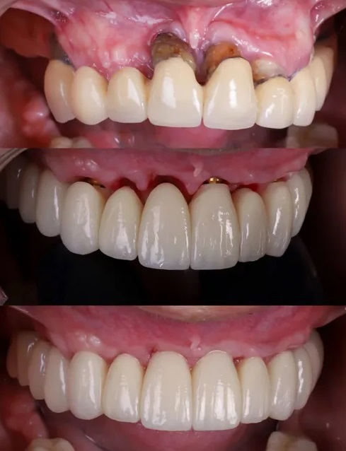 mejores implantes dentales en madrid en el mismo día con carga inmediata