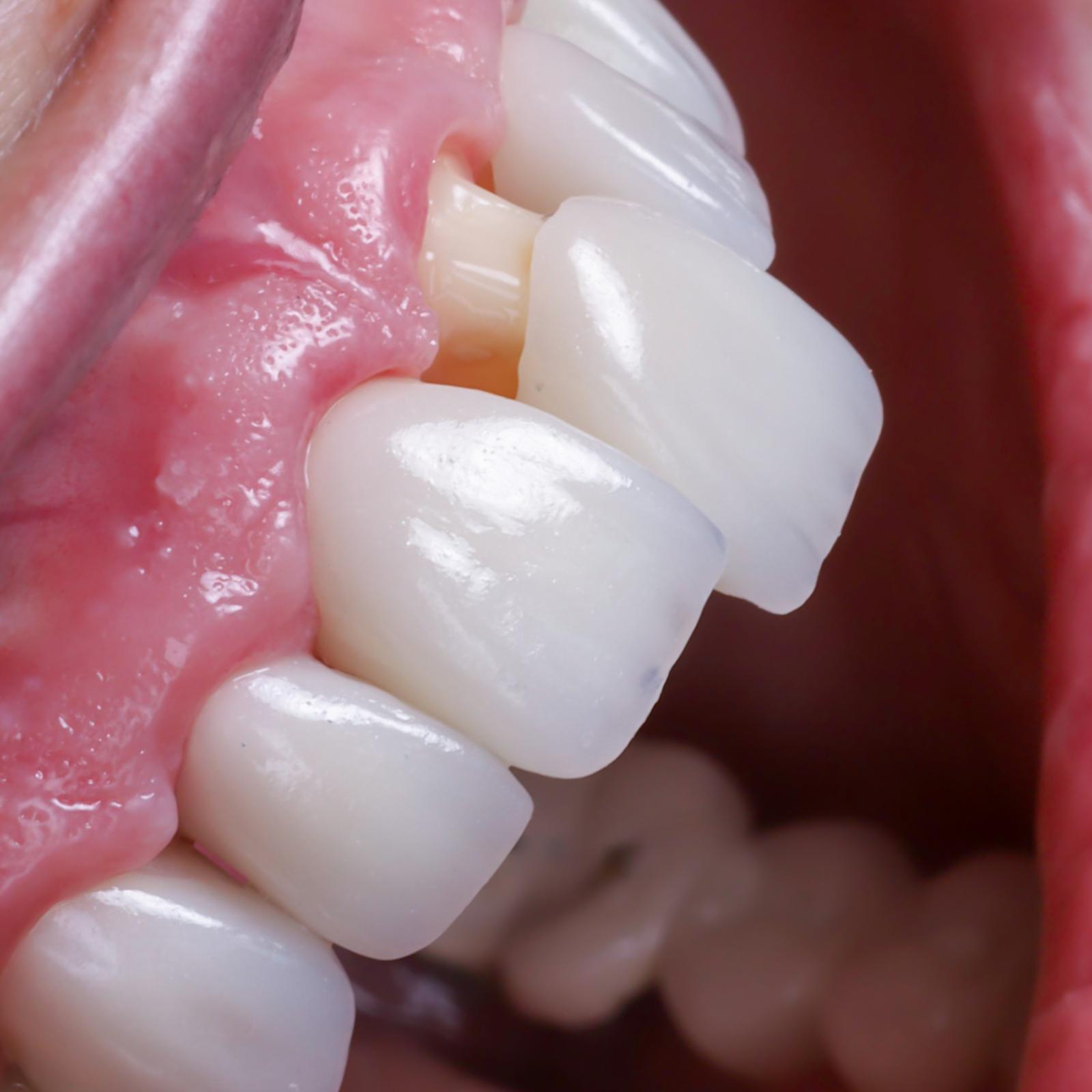 Diferencia entre carillas y fundas dentales