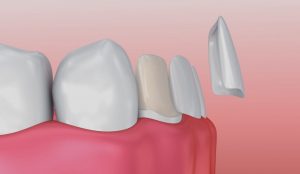carillas de porcelana