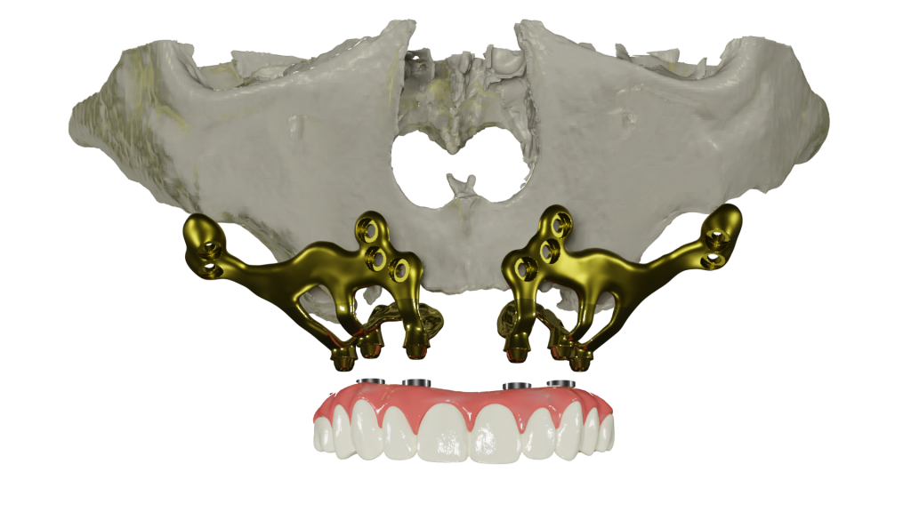 implantes yuxtaóseos para pacientes sin hueso