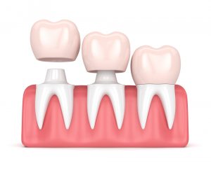 Precio fundas dentales toda la boca​ en madrid