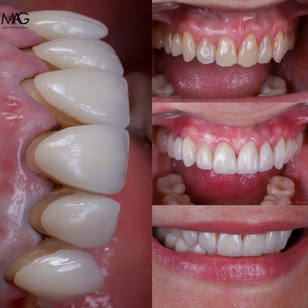 fotos carillas antes y después