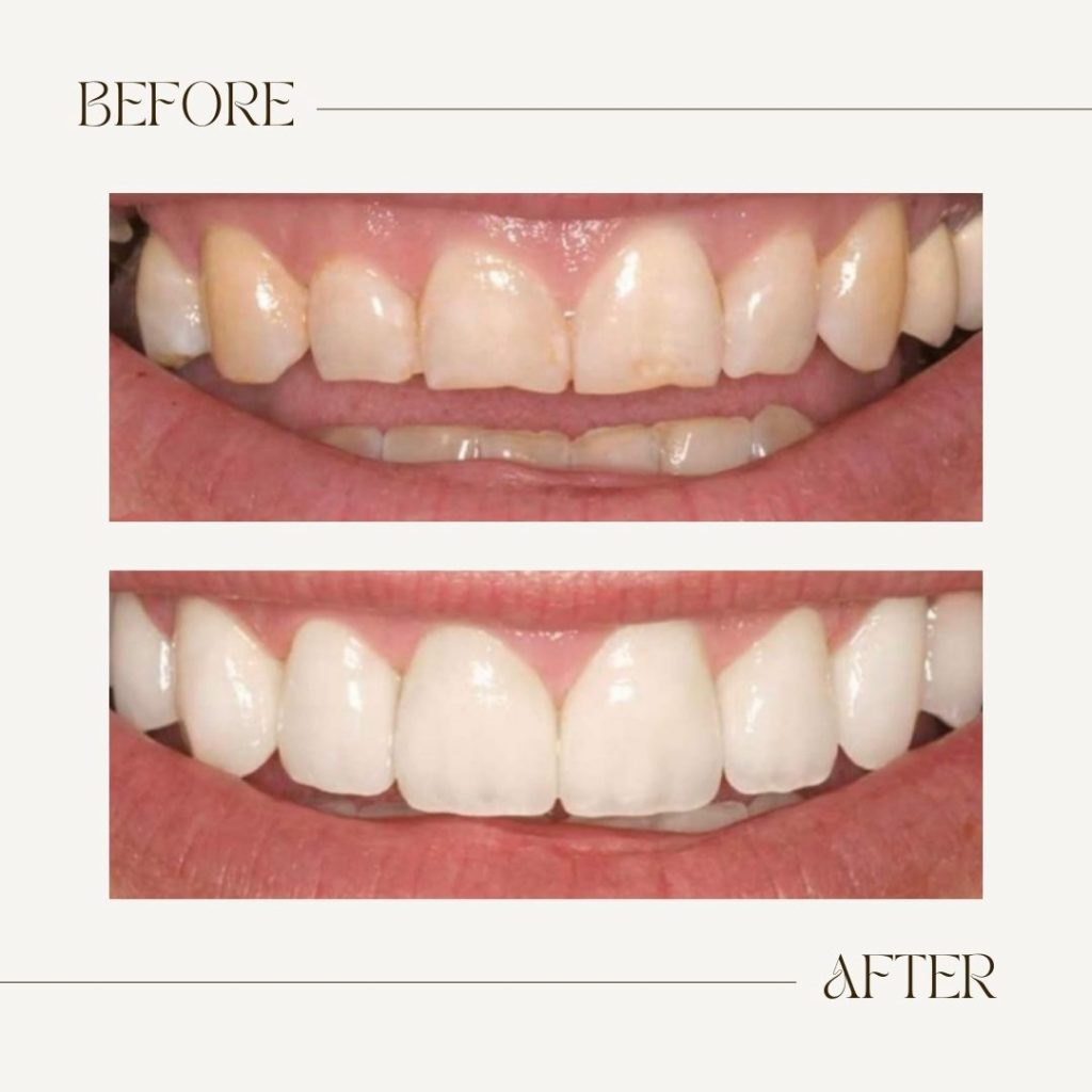 antes y después blanqueamiento dental en casa