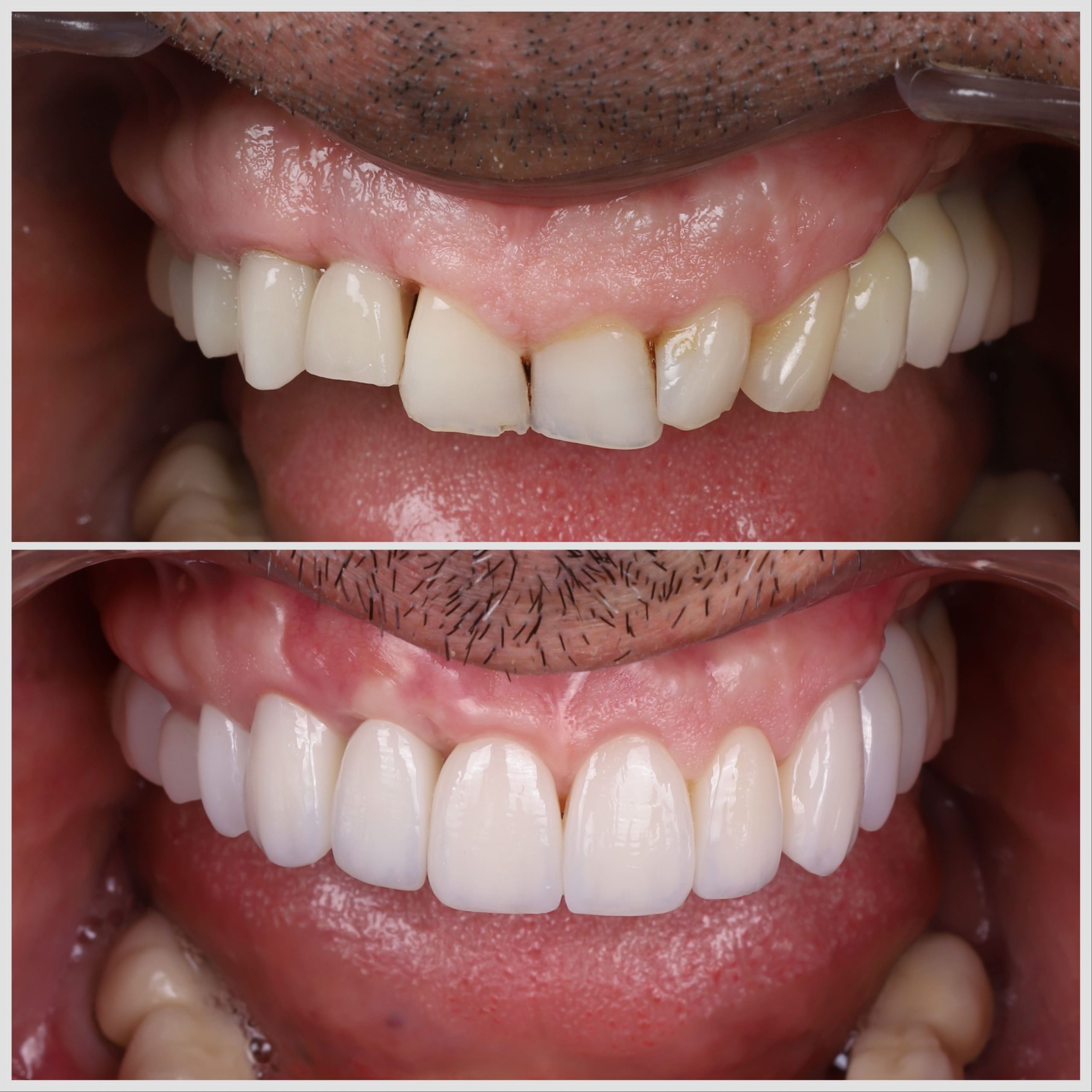 como se pone una carilla dental​
