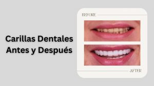carillas dentales antes y después