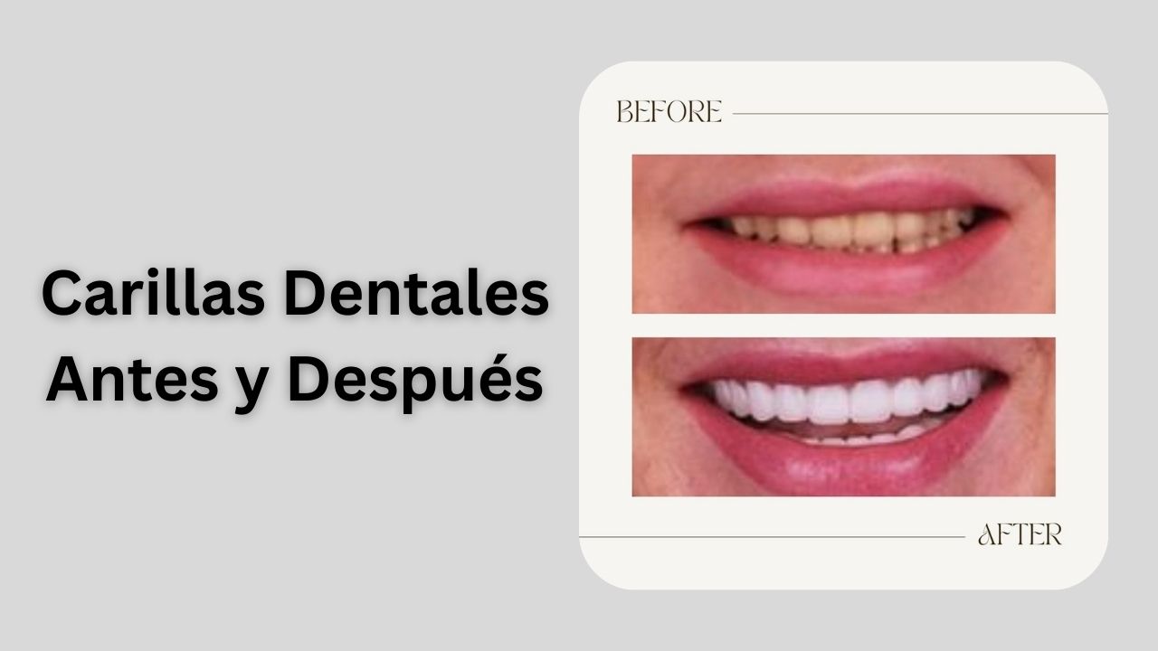 carillas dentales antes y después