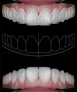 Diseño digital de sonrisa para carillas de porcelana