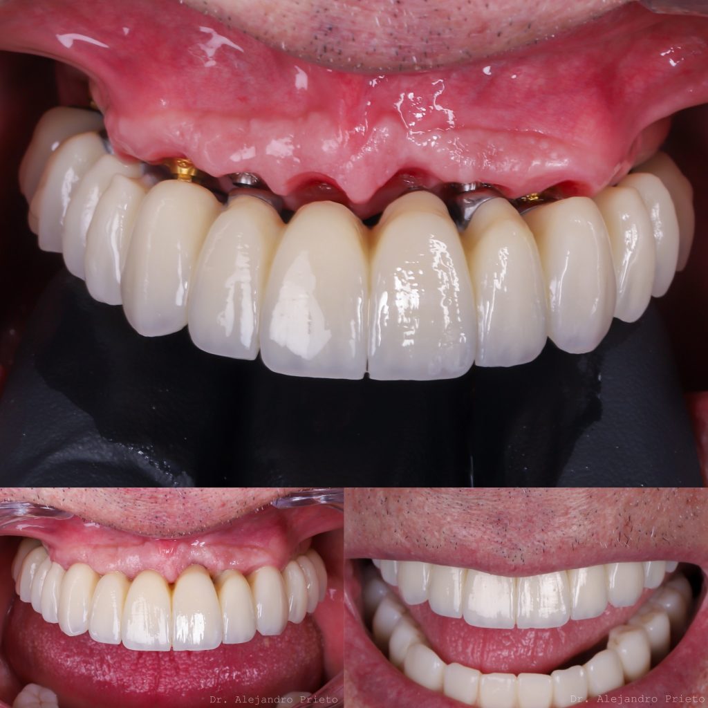 prótesis sobre 6 implantes