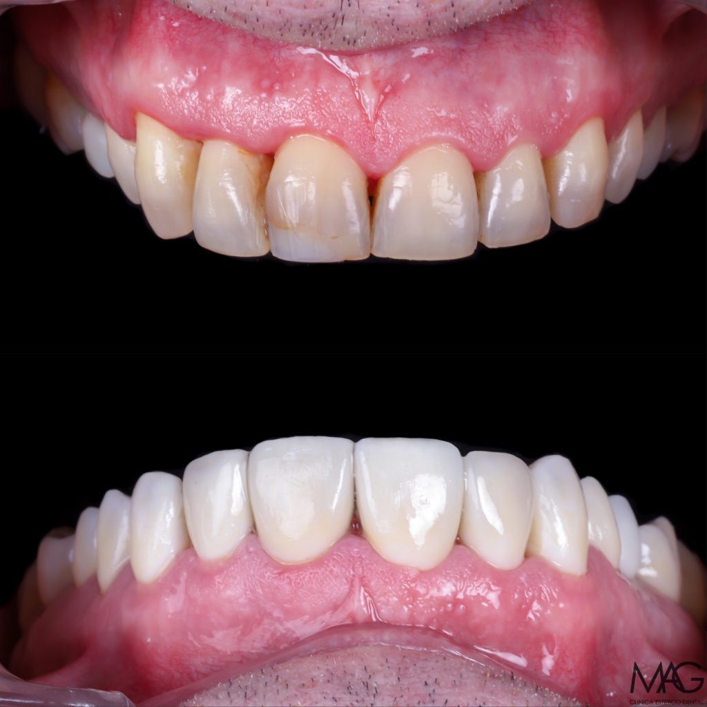 foto de carillas dentales en madrid