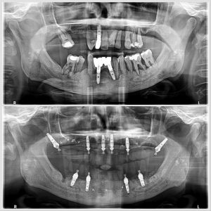 radiograf&iacute;a antes y despu&eacute;s de colocaci&oacute;n implantes con cirug&iacute;a guiada