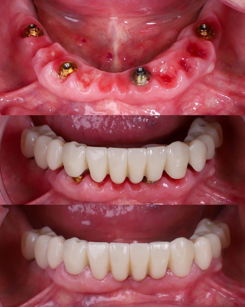 prótesis sobre 4 implantes