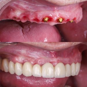 foto de puntos después de poner implantes dentales