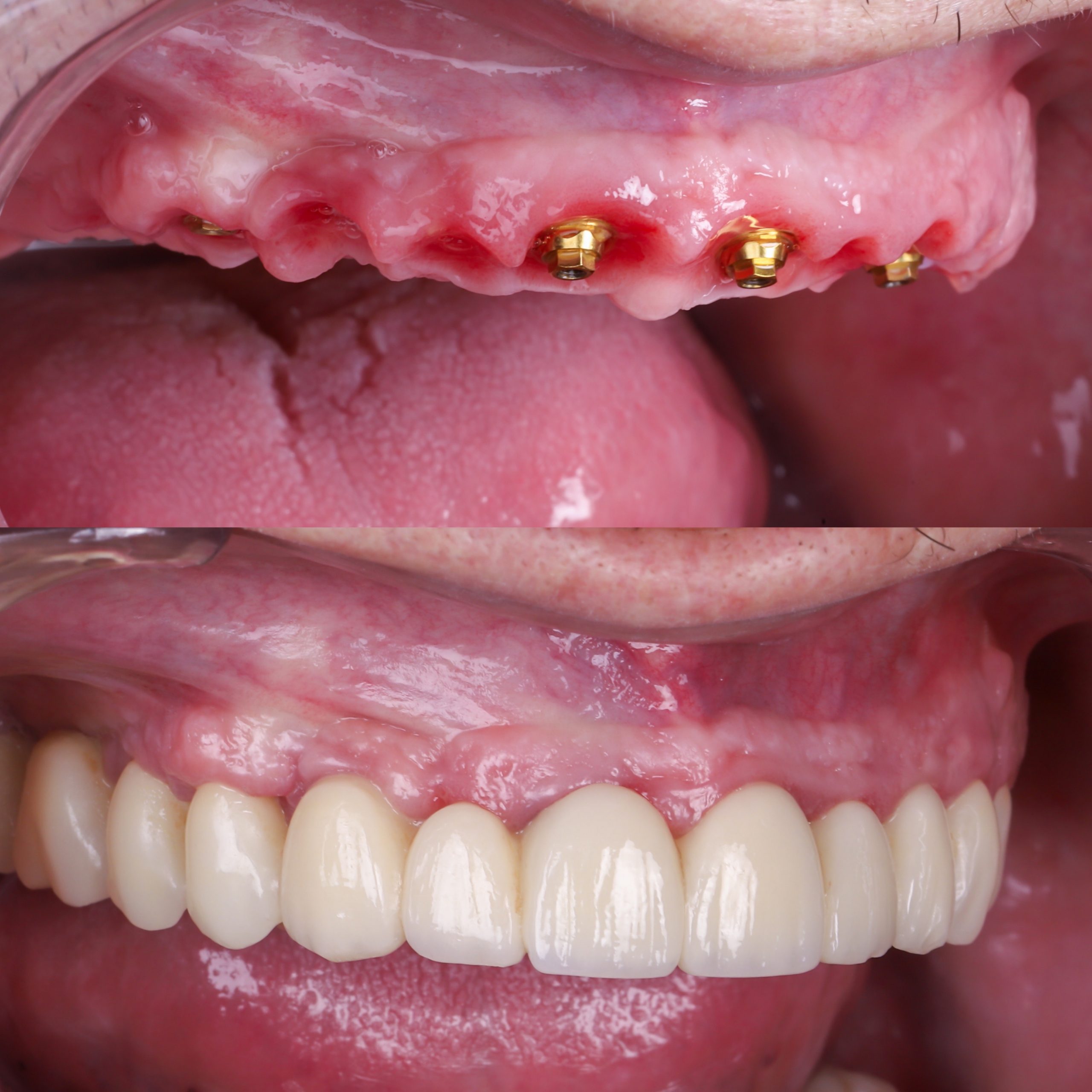 Implantes dentales: antes (oro) y después (blanco).