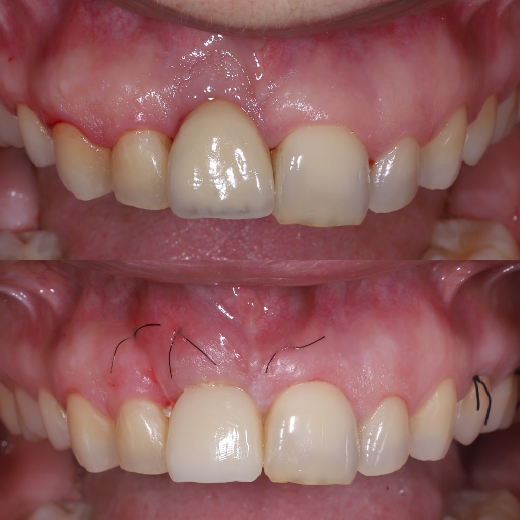 caso de encías retrañidas antes y después