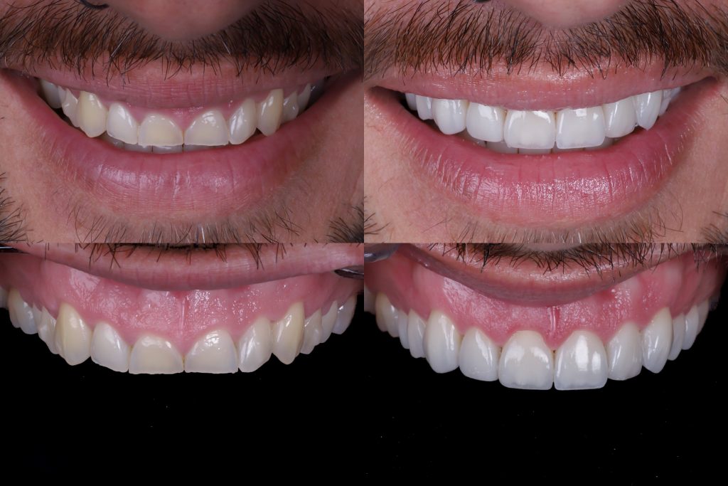 caso real carillas porcelana