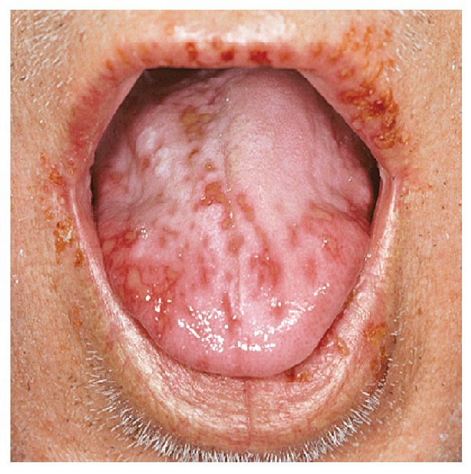 por qué salen llagas en la boca llaga