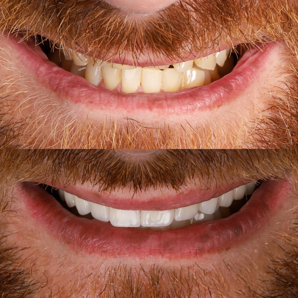 fotos carillas antes y después