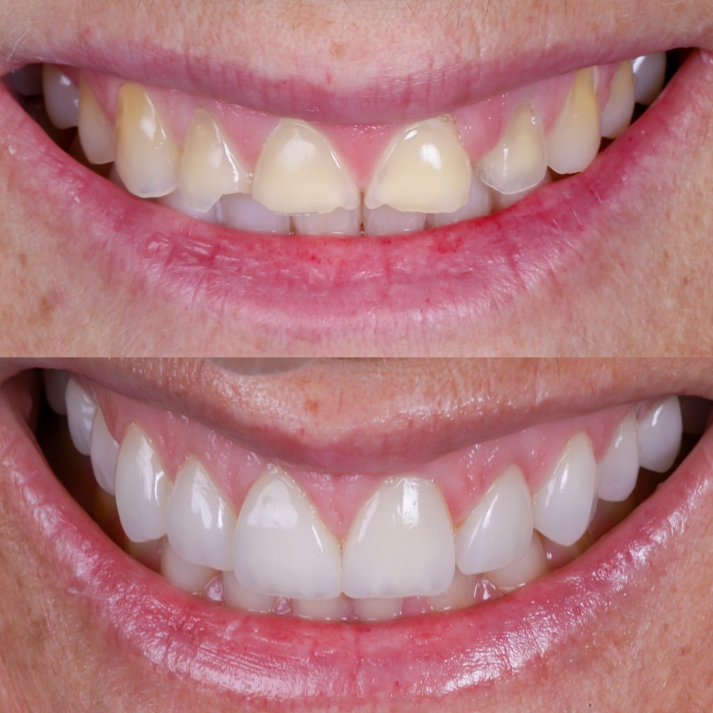 fotos carillas antes y después