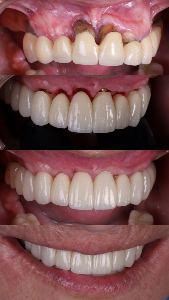 pérdida de hueso por enfermedad encías periodontitis
