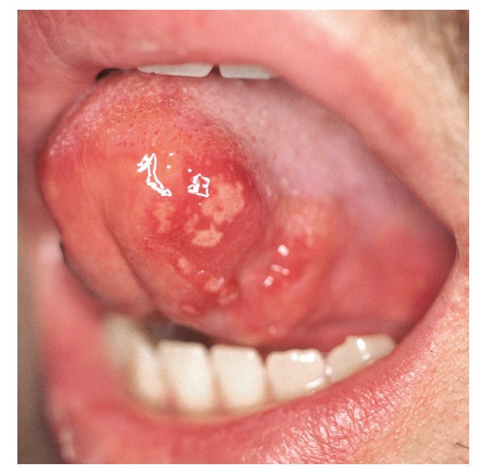 por qué salen llagas en la boca? llaga herpetiformes