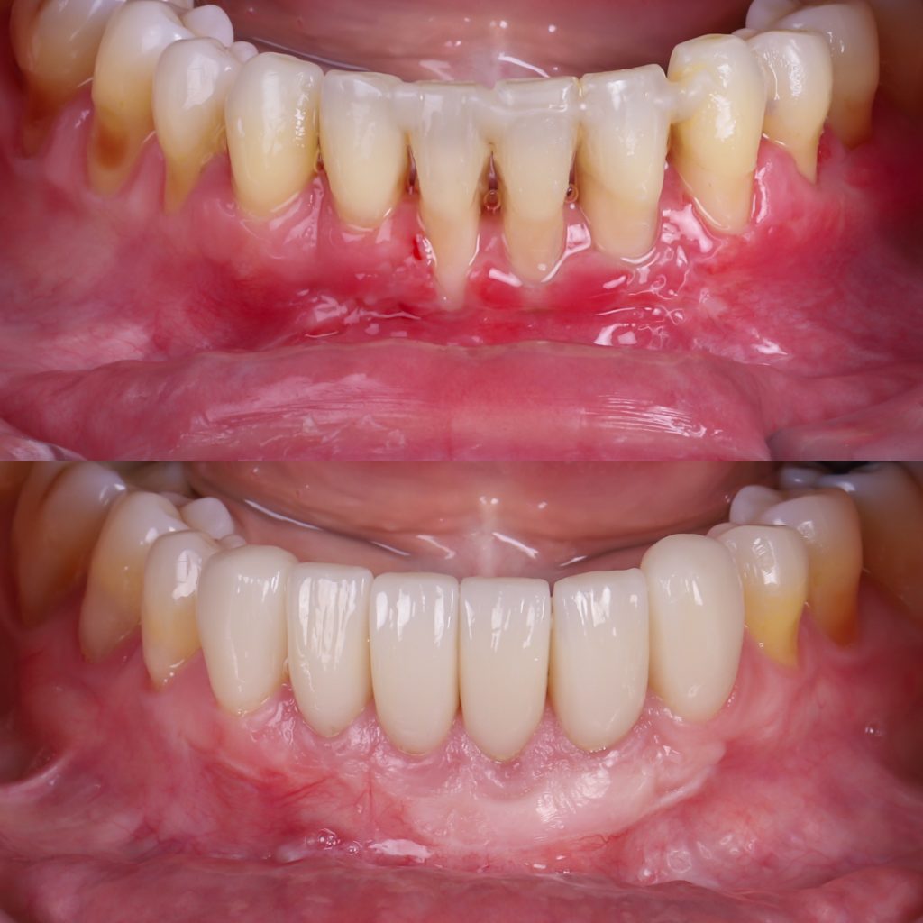 fotos de encías retraídas