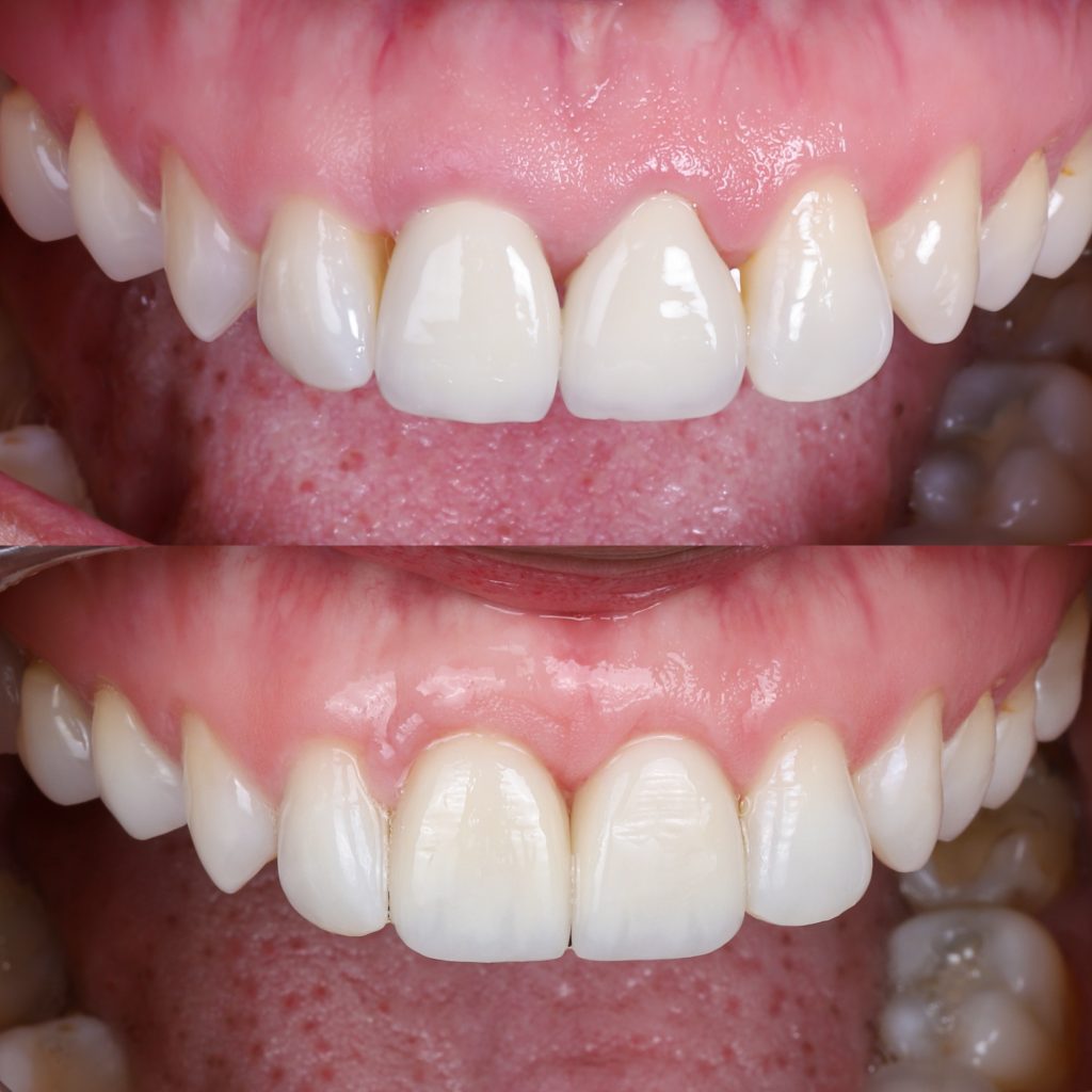 fotos de encías retraídas