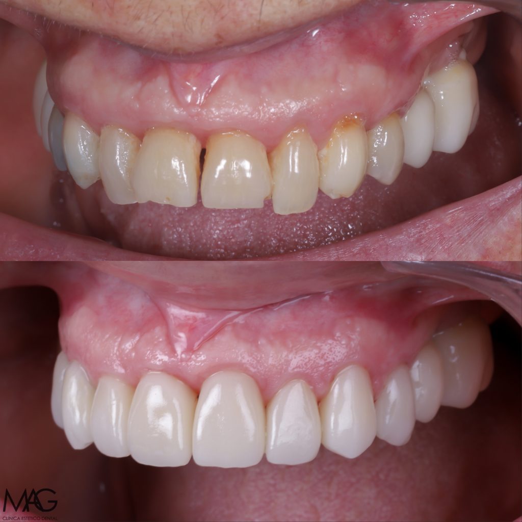 Foto antes y después de carillas dentales en Madrid