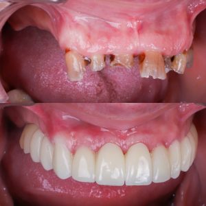 foto antes y despu&eacute;s de dentadura fija completa 