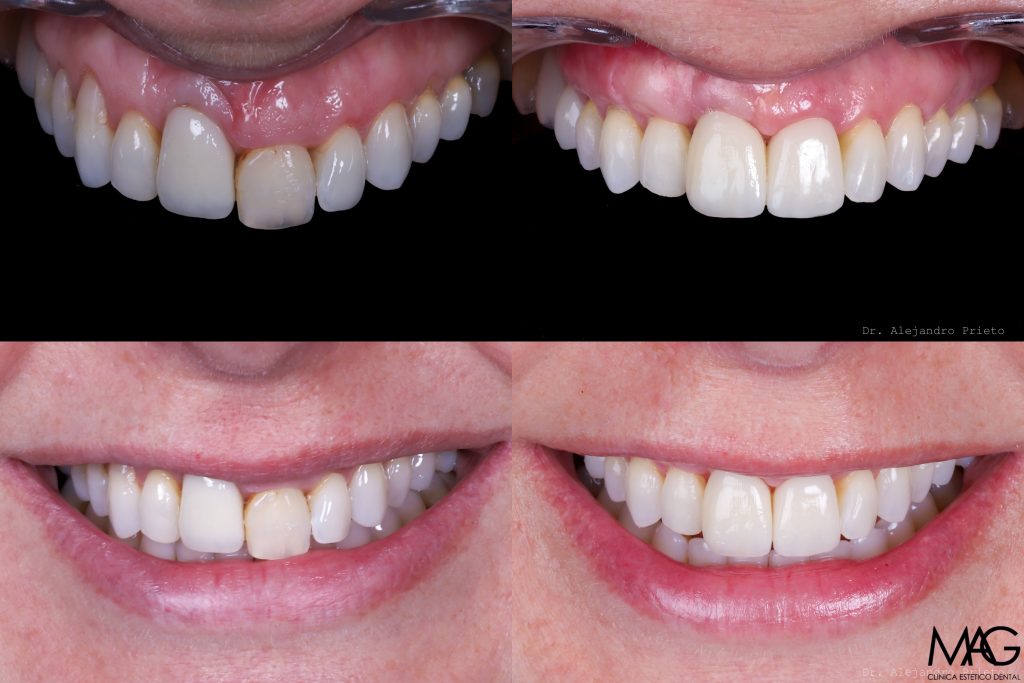 fotos de encías retraídas antes y después