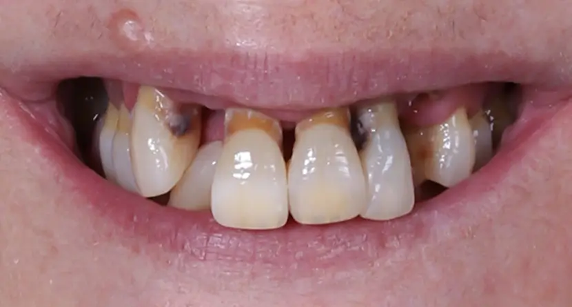 antes y después implantes boca completa