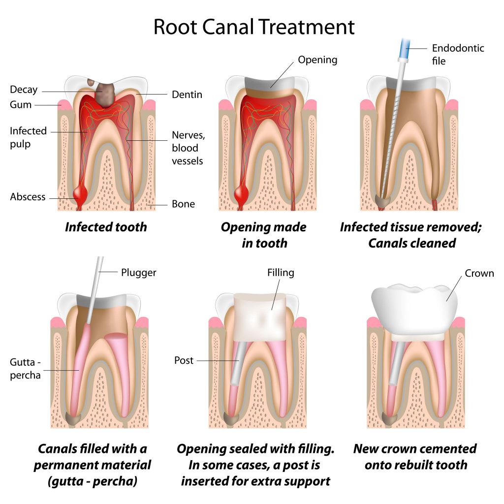 endodoncia remedio a dolor de muelas por caries avanzada