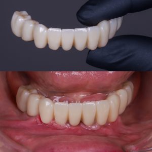foto de dentadura fija completa sobre implantes