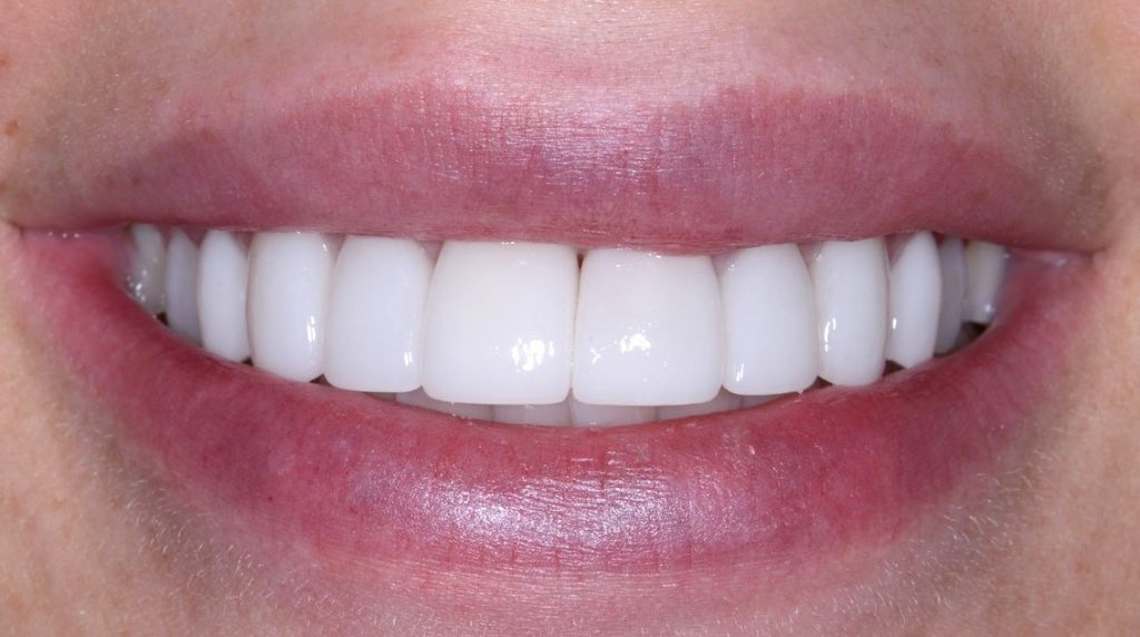 opiniones sobre las carillas de composite