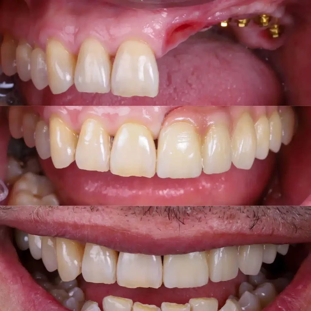 implantes de muela sin hueso para implantes