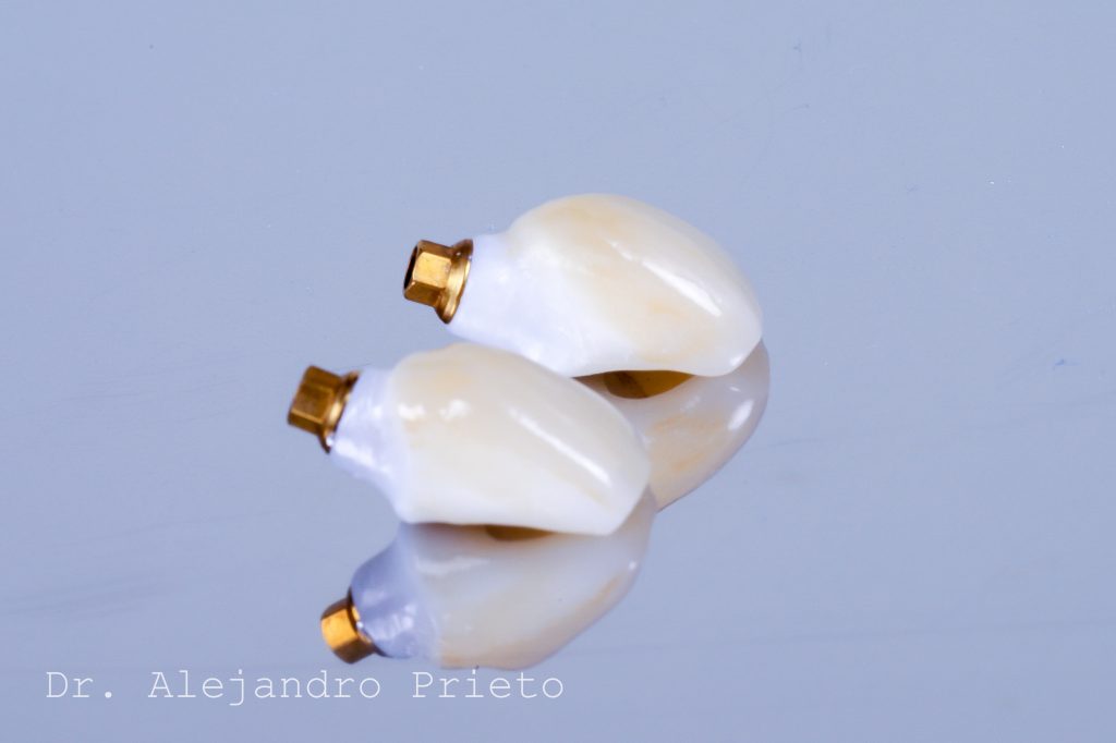 prótesis para implantes dentales modernos