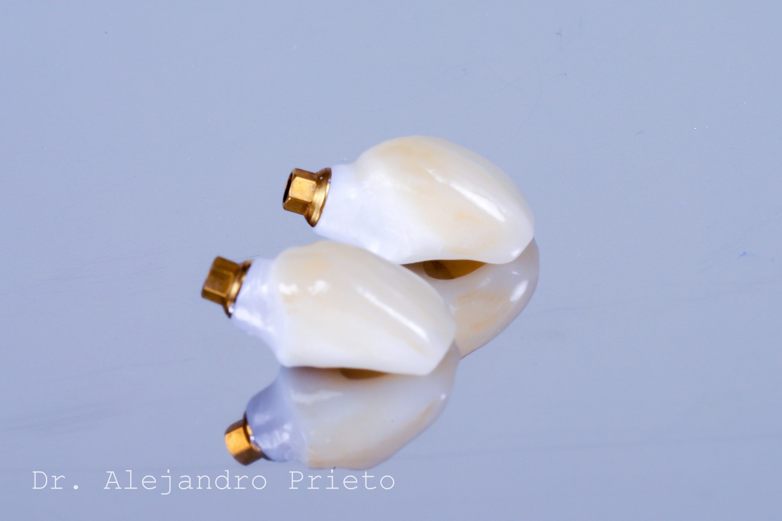 Coronas dentales de zirconia con base metálica dorada.