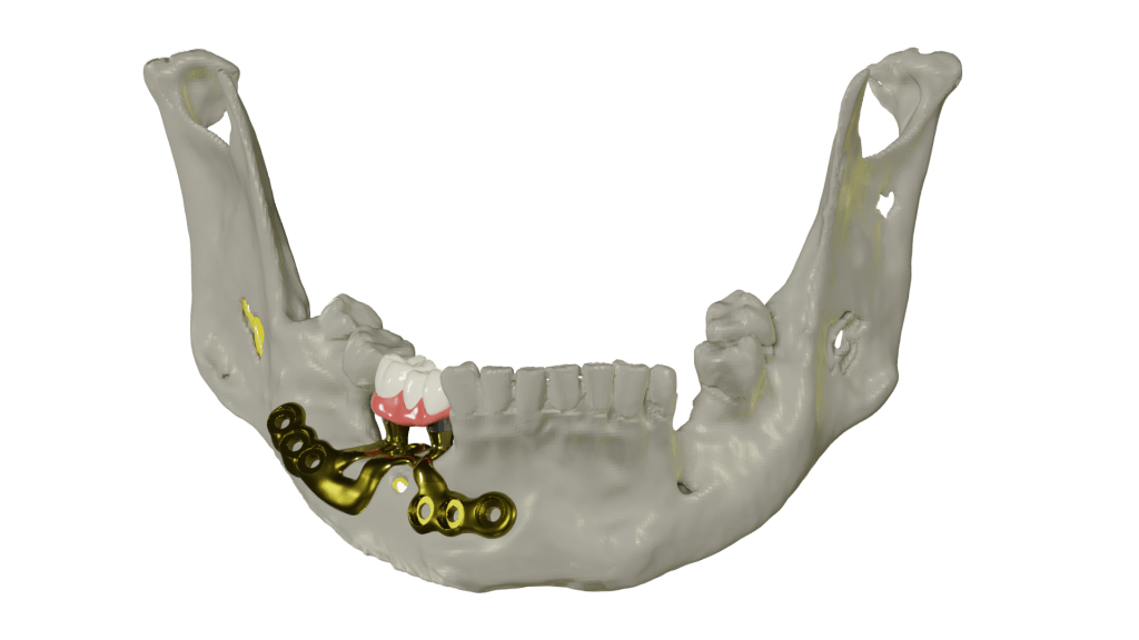 imagen de implantes yuxtaóseos