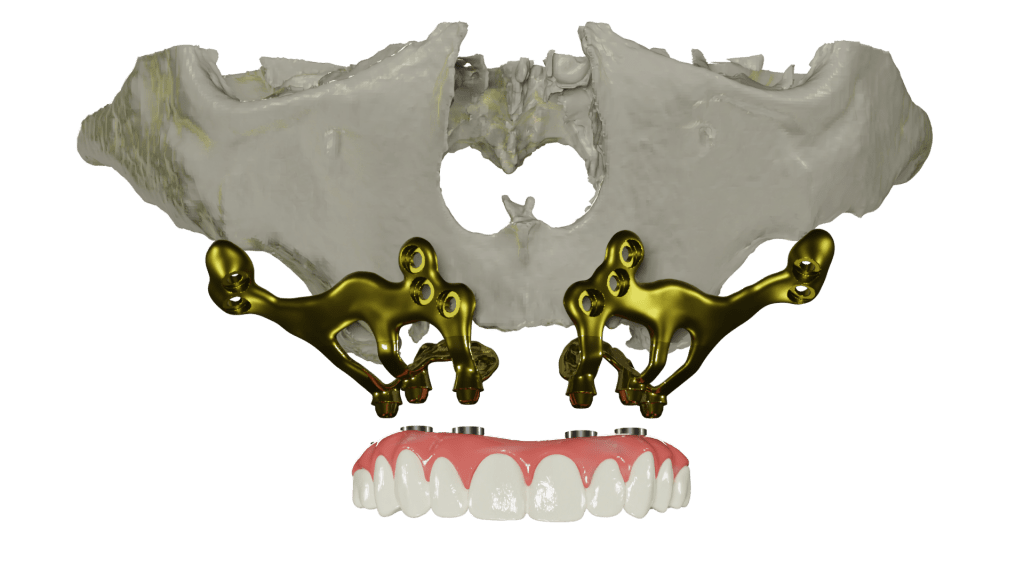 implantes yuxtaóseos para pacientes sin hueso