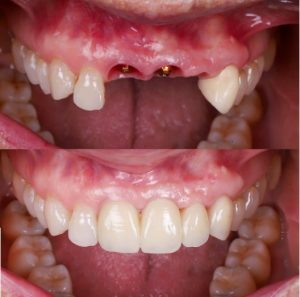 precio implante dental en Madrid en 2025