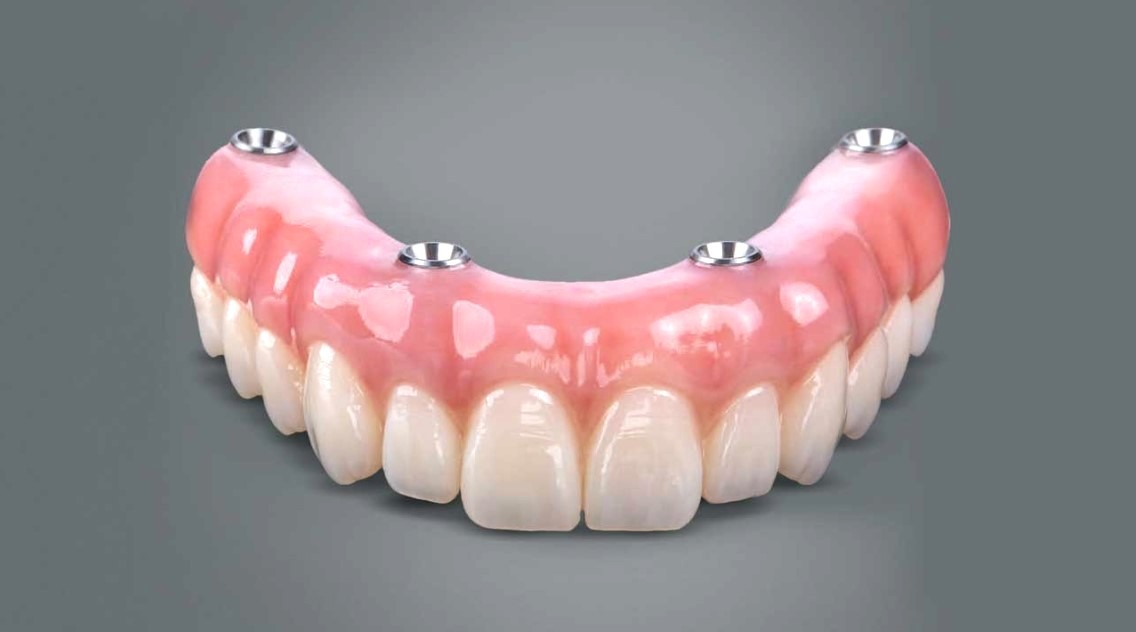 Prótesis dental completa superior anclada con cuatro implantes.
