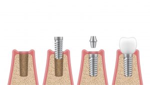 implantes dentales proceso de colocaci&oacute;n y tiempo 