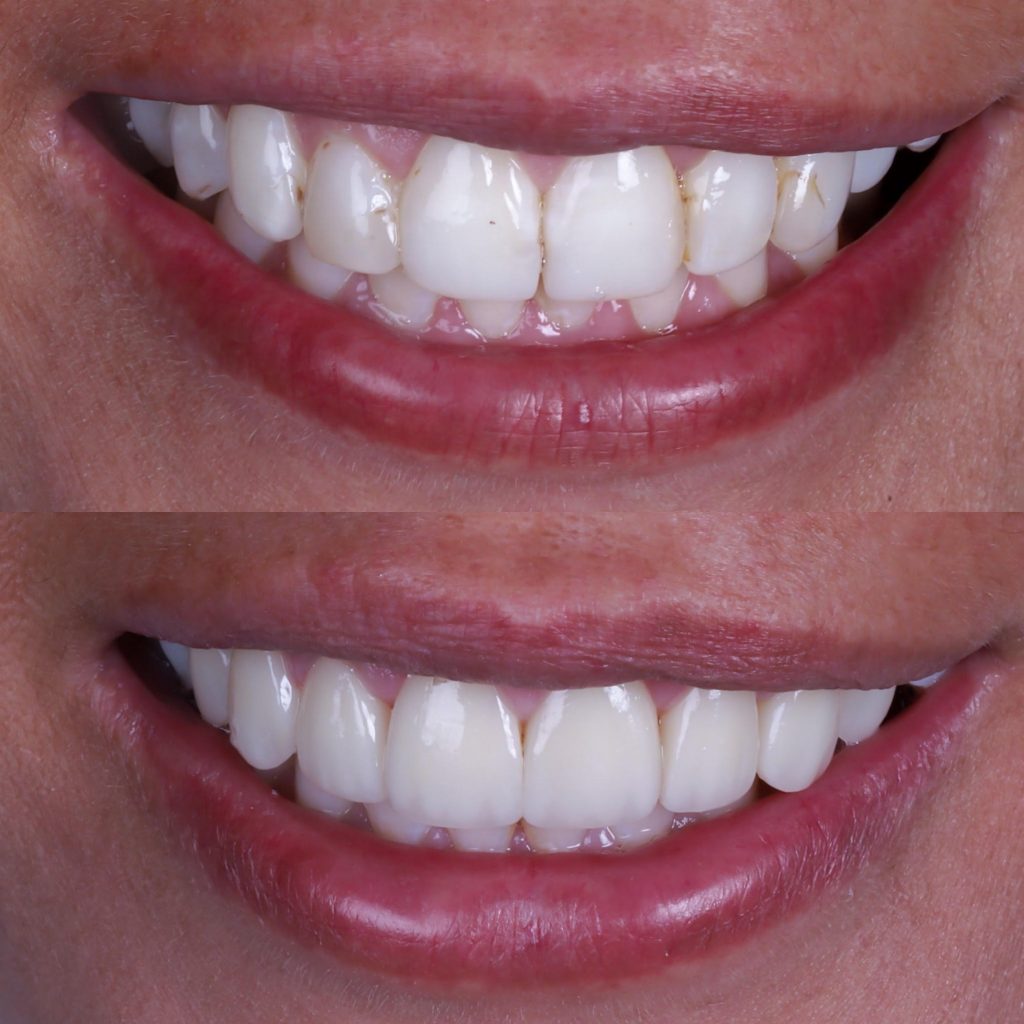 diferencia carillas de composite y carillas de porcelana