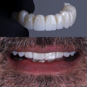 implantes dentales proceso de colocaci&oacute;n