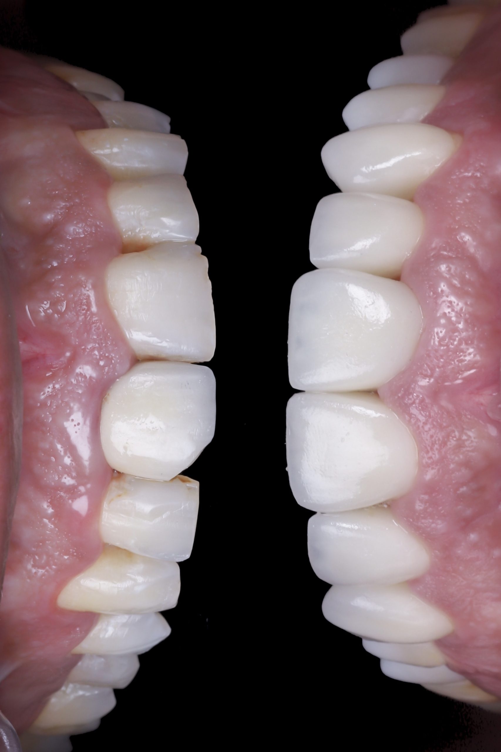 antes y después carillas sin tallado