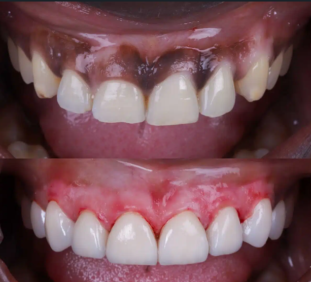 blanqueamiento de encías negras