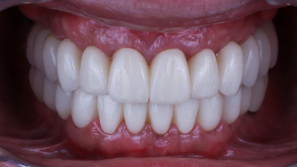 implantes dentales con carga inmediata implantes en un solo día