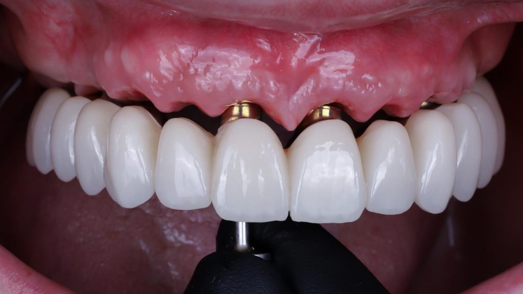 Implantes dentales carga inmediata en madrid