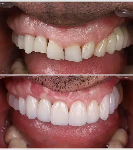 carillas dentales sin tallado